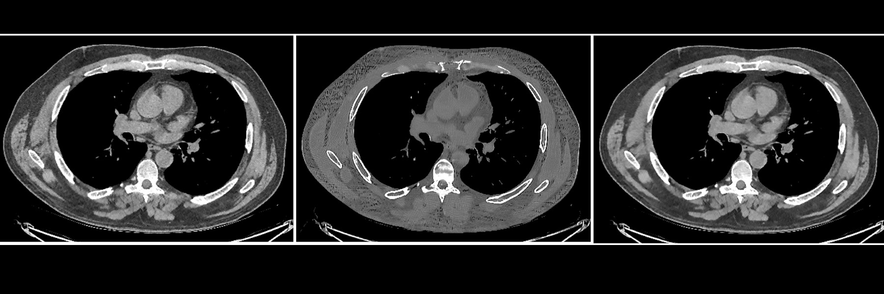 Image Of A Reduced-dose Chest CT Scan Reconstructed.